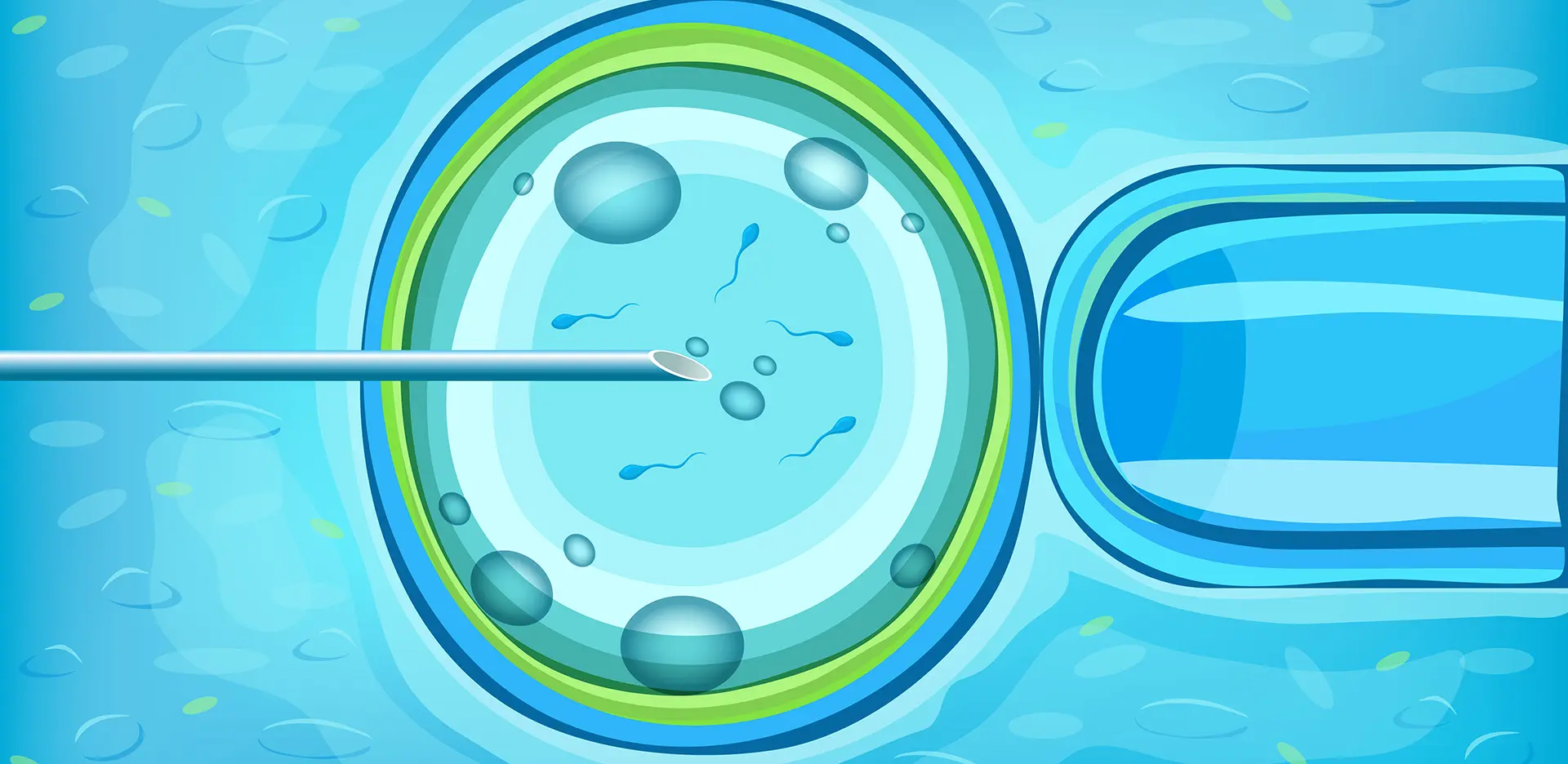การทำอิ๊กซี่ (ICSI)